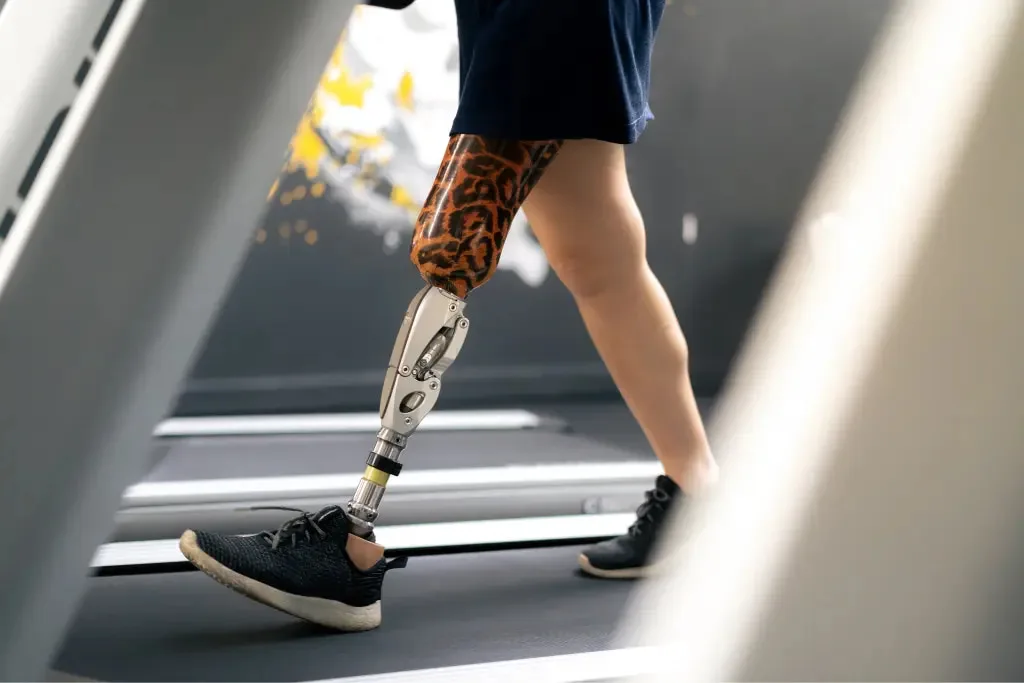 challenges of running with a prosthetic leg