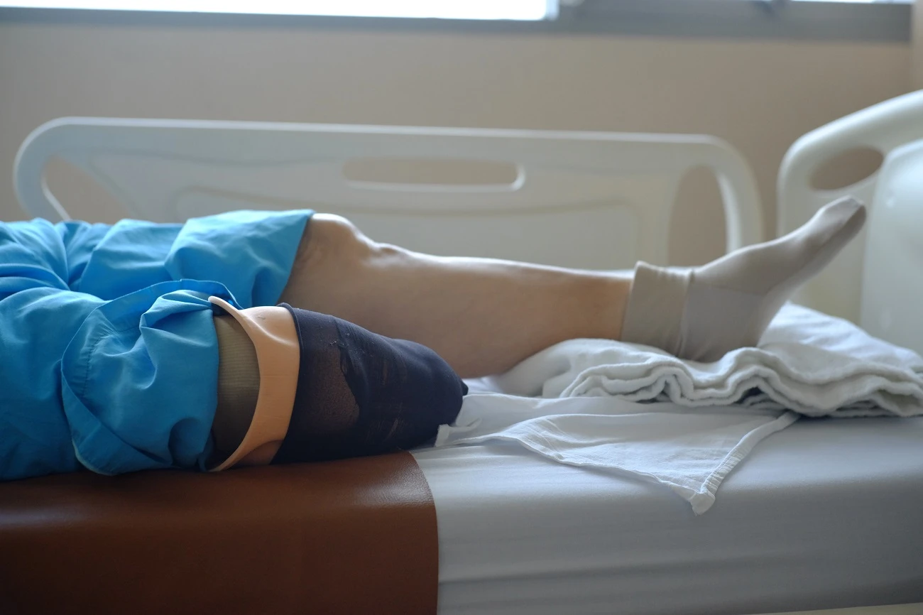Amputated Limb