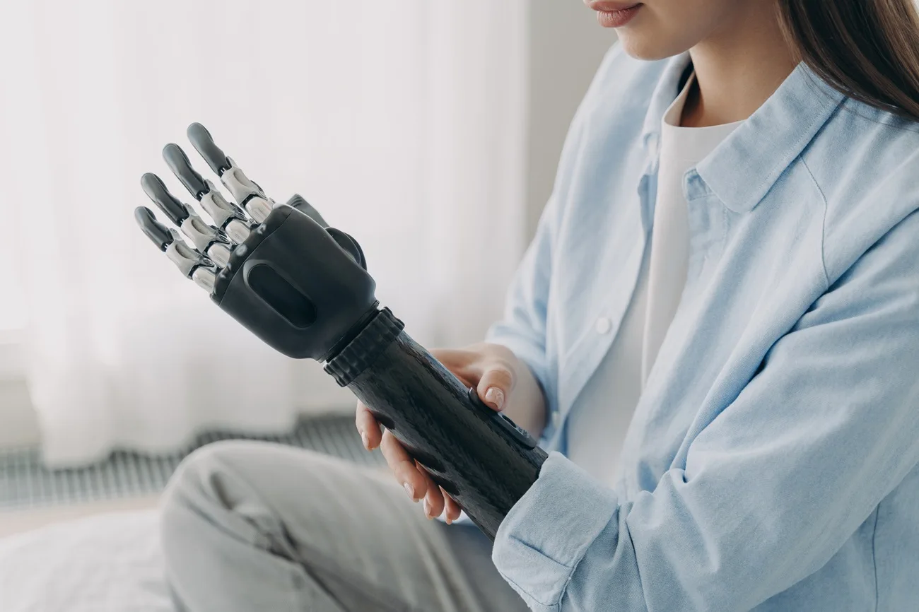 lifestyle with a prosthetic leg