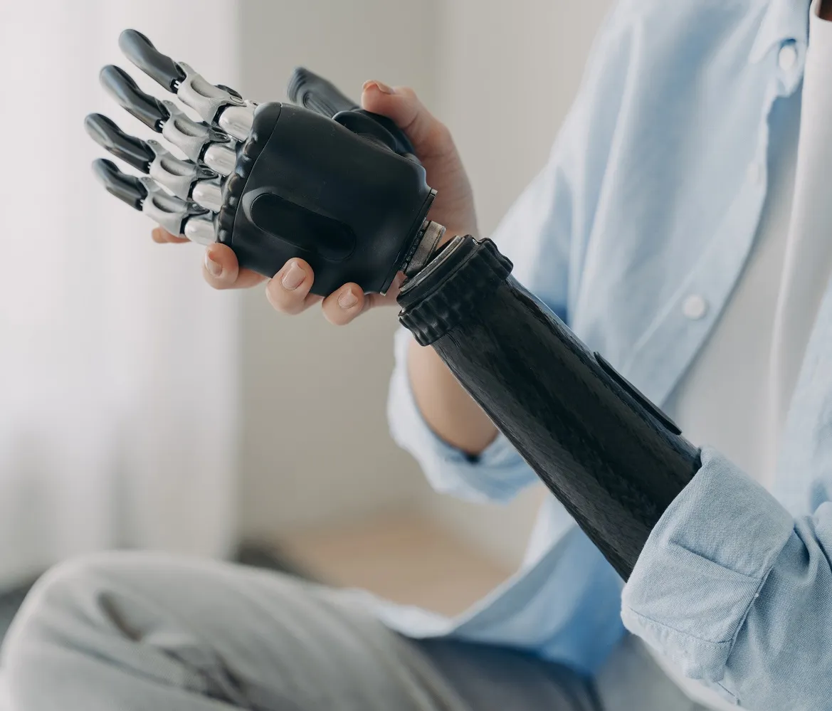 Person holding the myoelectric prosthetic hand on their forearm