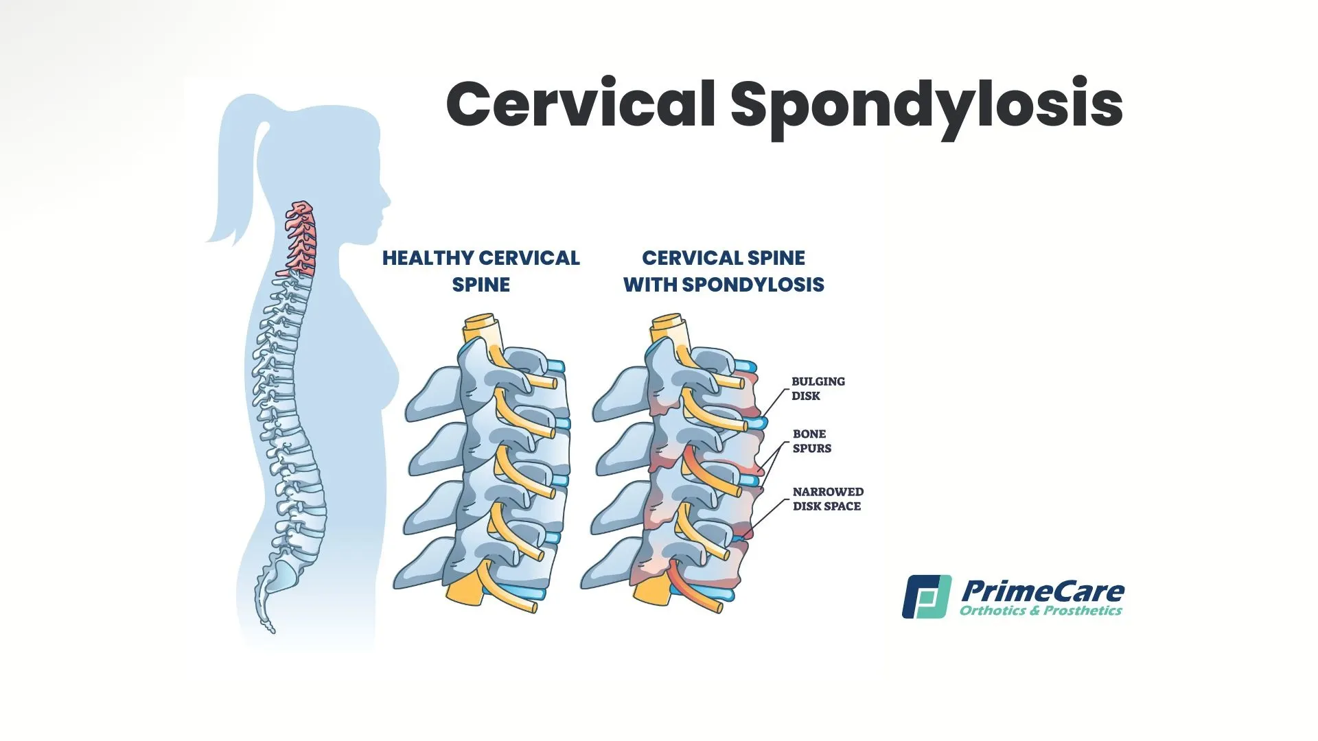 Espondilosis cervical