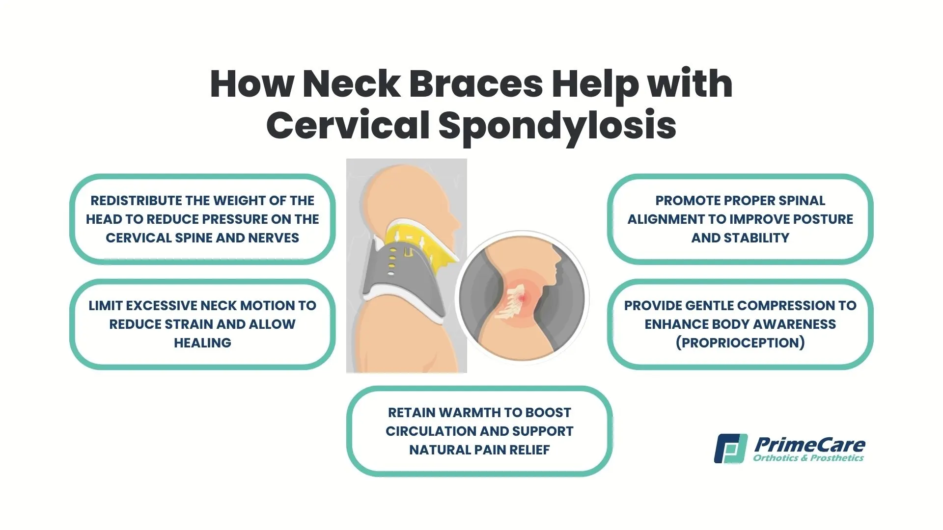 Cómo ayudan los collarines con la espondilosis cervical