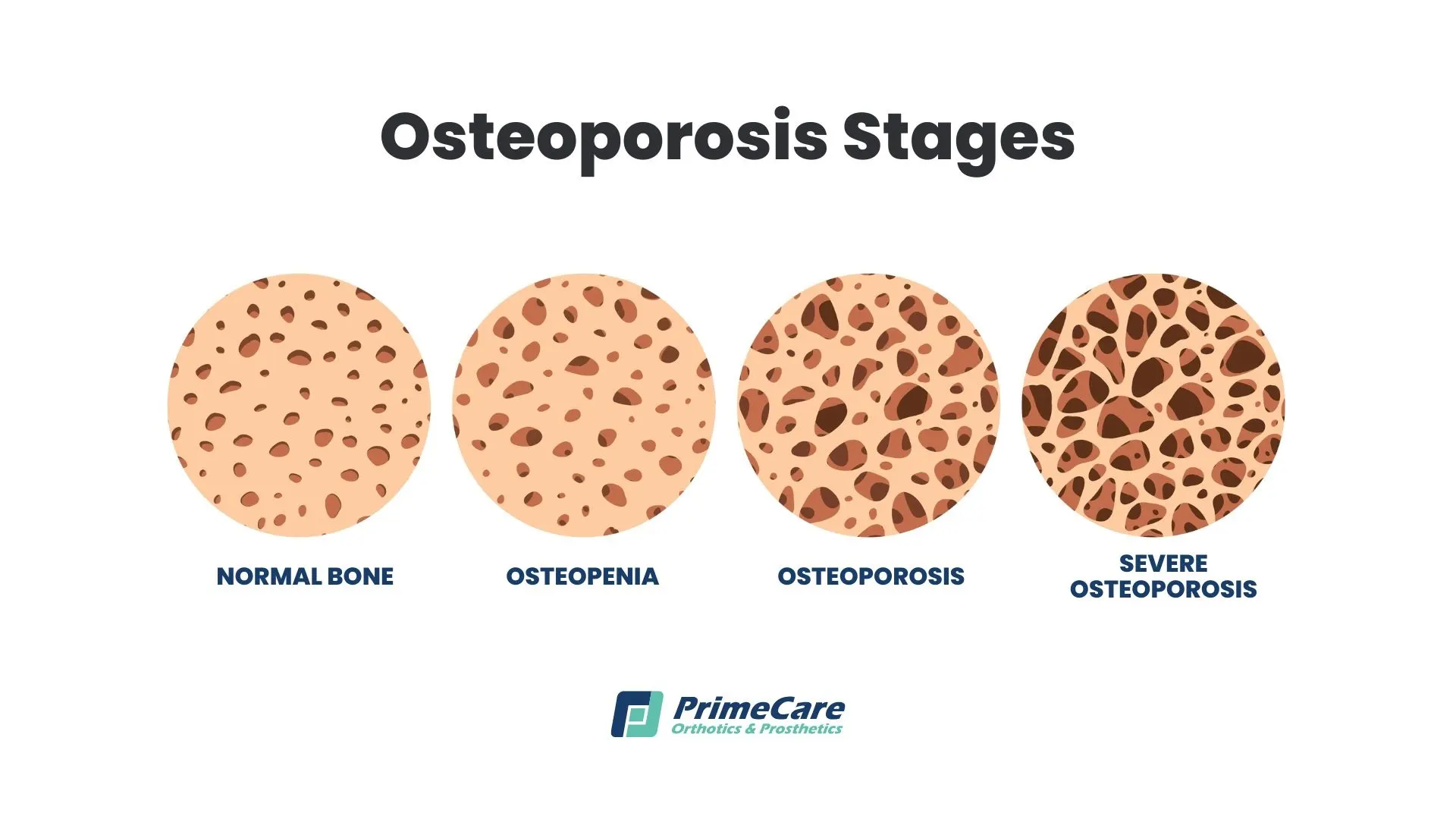 Osteoporosis stages